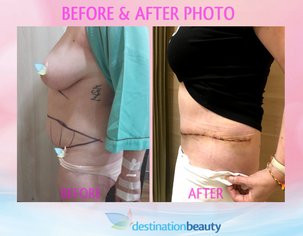 Maria's before and after extended tummy tuck thailand