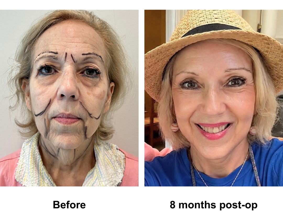 Marias 8 months post-facelift with Dr. Jatuporn