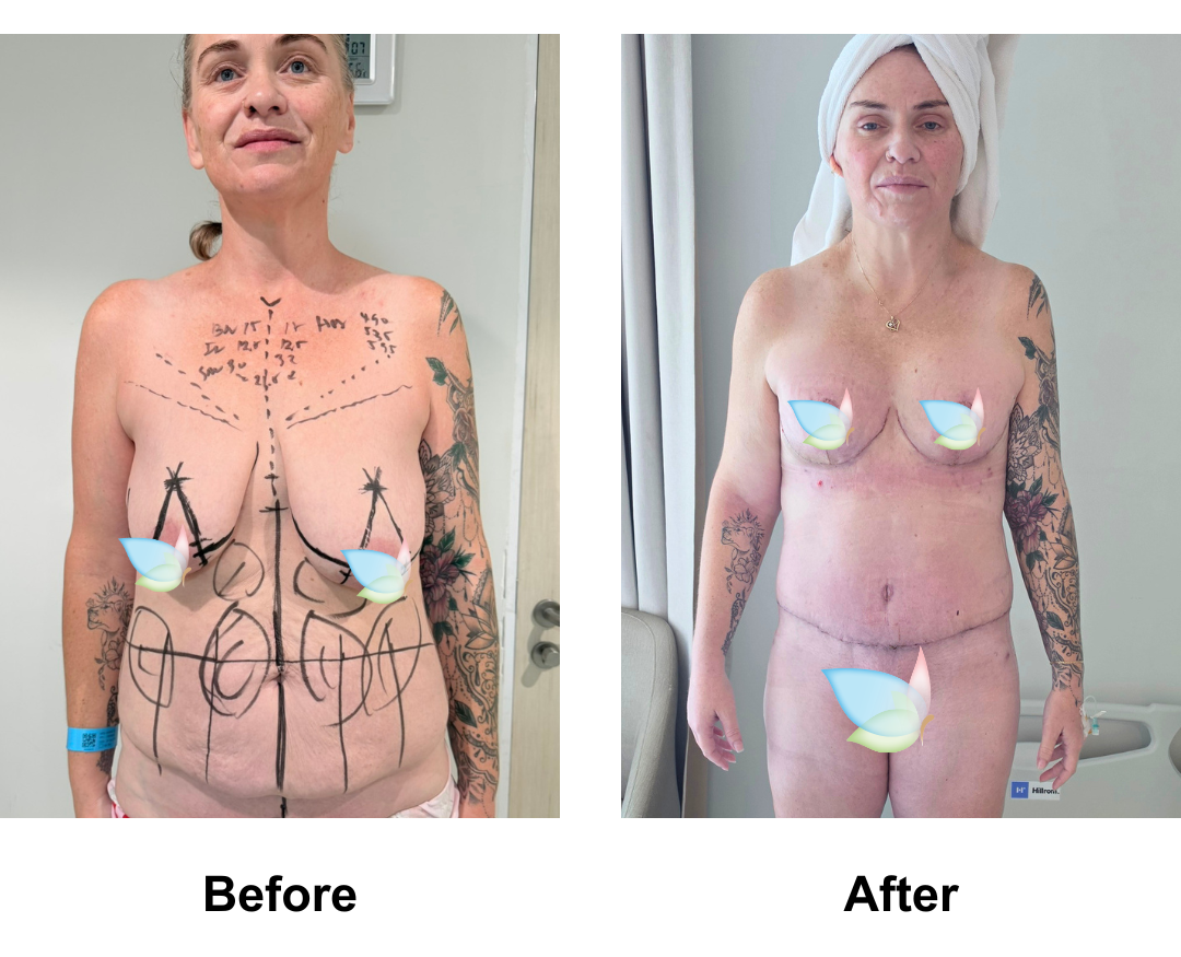 Marike had BABL (500 Motiva Full) + Nipple graft + ExTT + Lipo2 + Mons lift with Dr. Jatuporn (1)