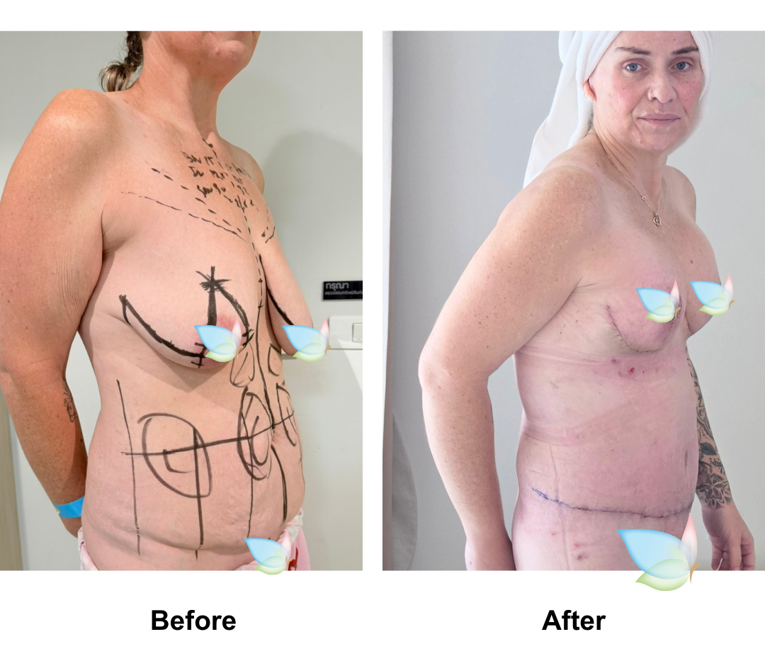 Marike had BABL (500 Motiva Full) + Nipple graft + ExTT + Lipo2 + Mons lift with Dr. Jatuporn