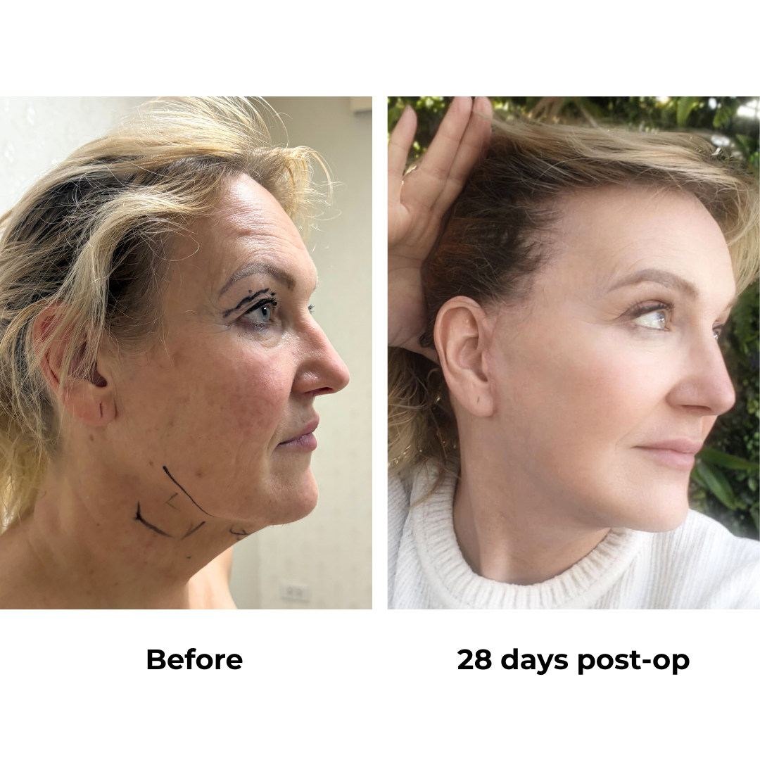 Martha had MFNL + Chin L + UB with Dr. Ring (2)