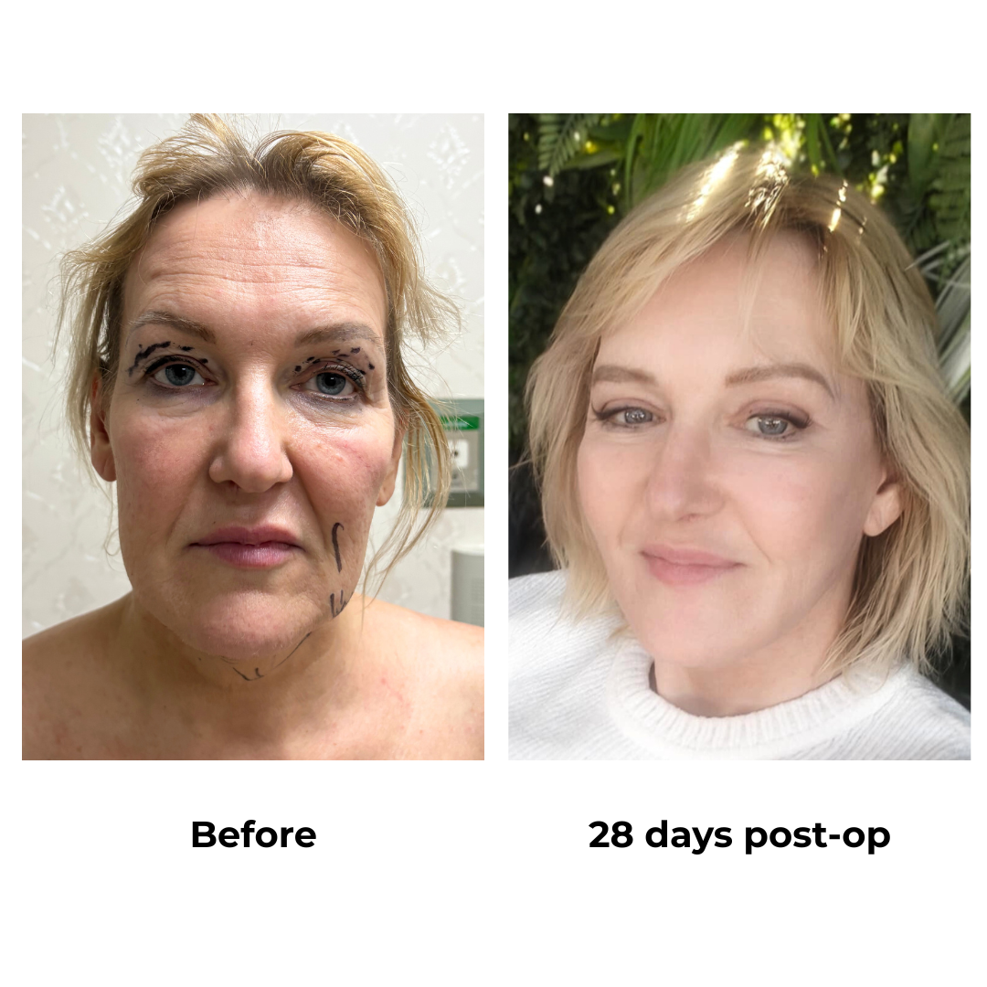 Martha had MFNL + Chin L + UB with Dr. Ring