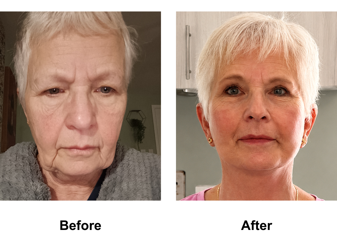 Martine had FFNL + Fat transfer to face + Sub Brow Lift with Dr. NJ (1)