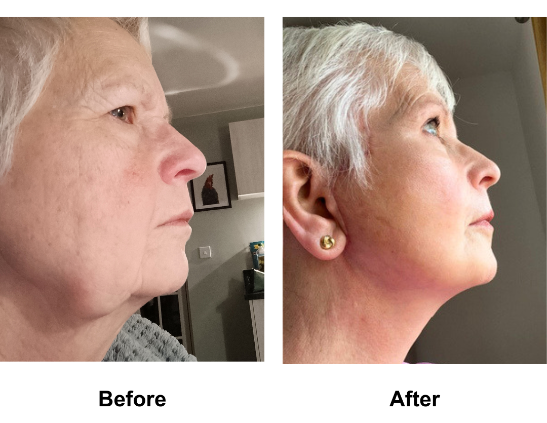 Martine had FFNL + Fat transfer to face + Sub Brow Lift with Dr. NJ (2)