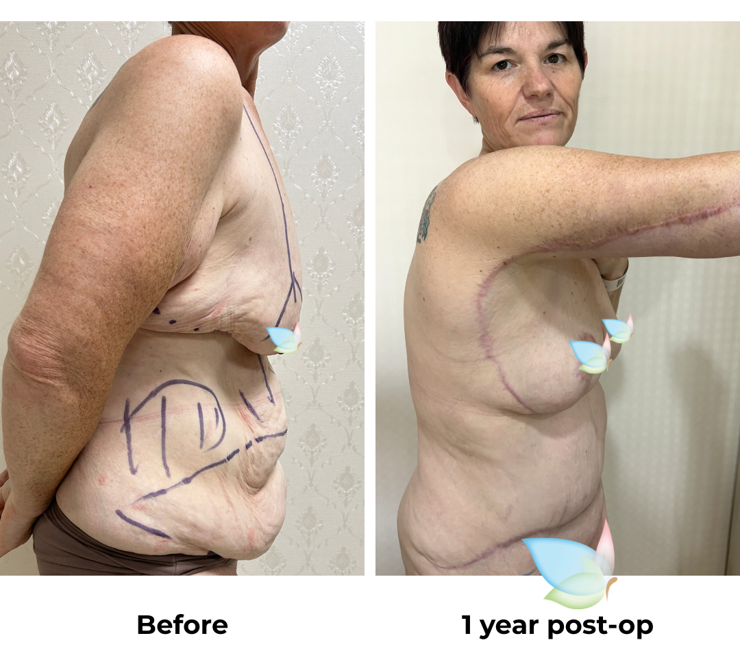 Mary - 1 year post op (1)