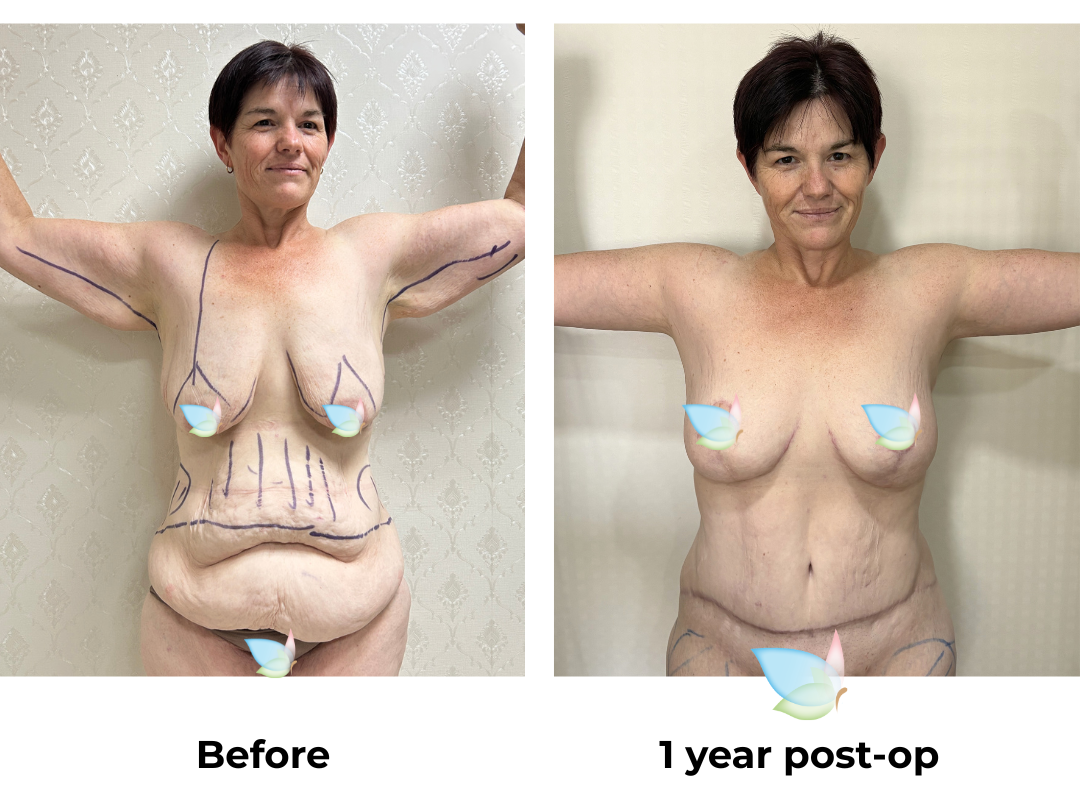Mary - 1 year post op