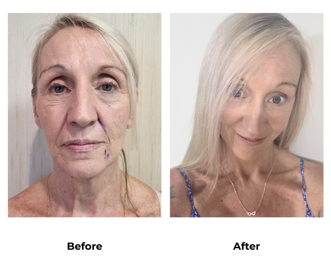 Mary had FFNL + Plastymaplasty with Dr. NJ - 1 month (2)