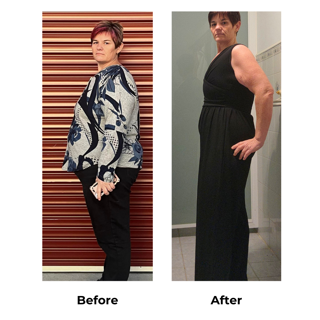 Mary had gastric sleeve (2)