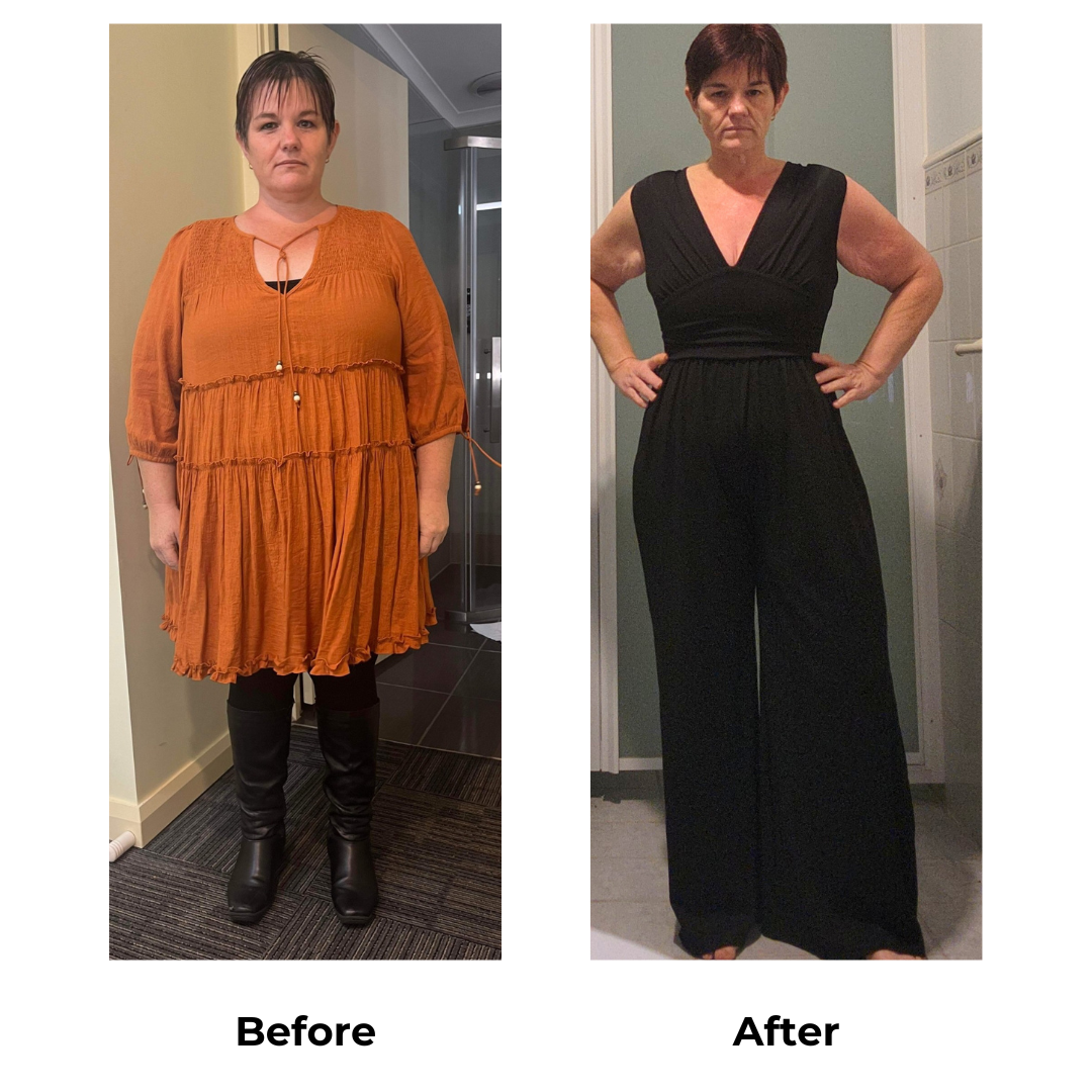 Mary had gastric sleeve (3)