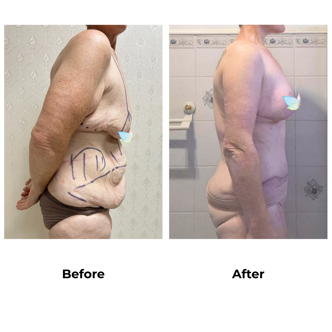 Mary had skin removal with Dr. Ring - 6 weeks (1)