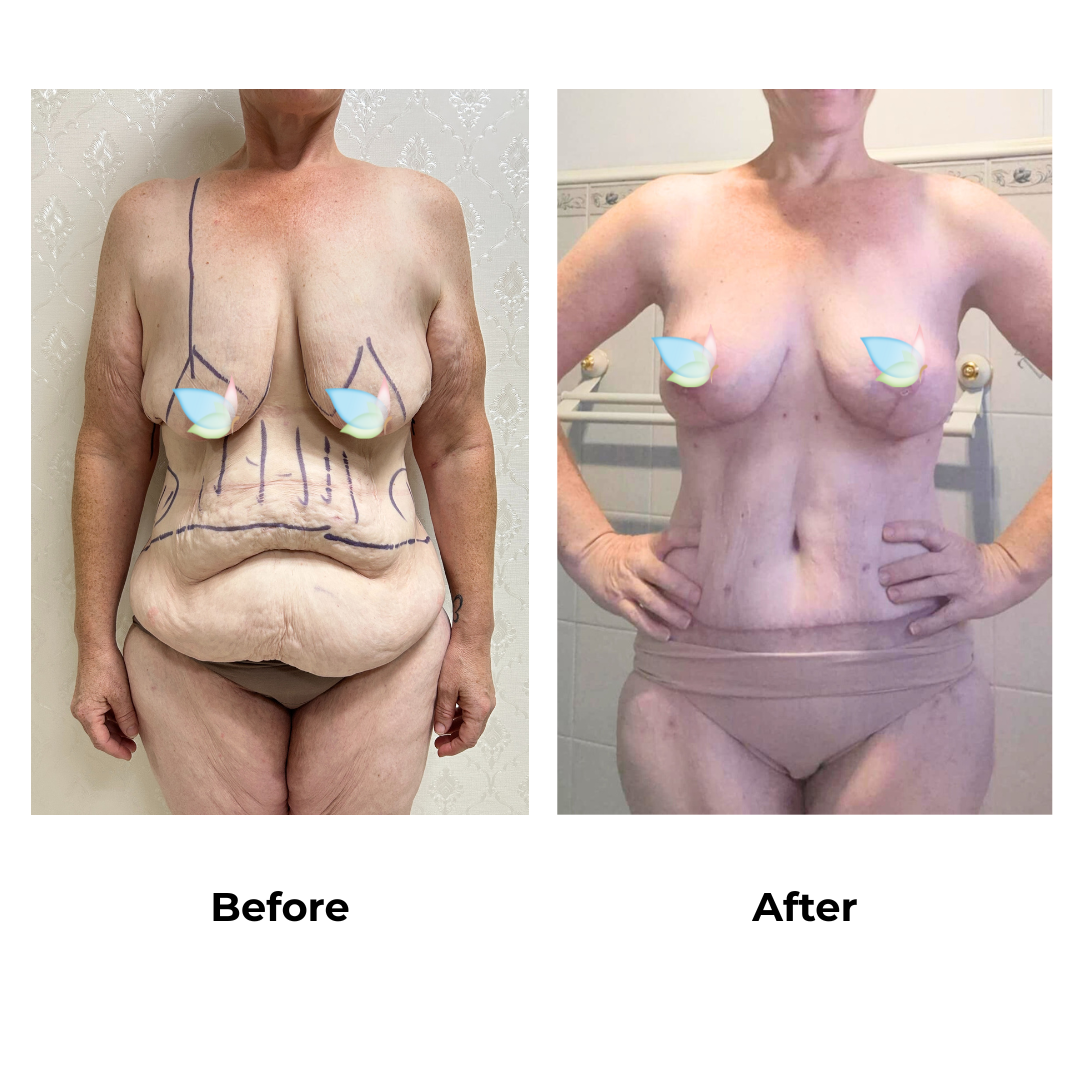 Mary had skin removal with Dr. Ring - 6 weeks