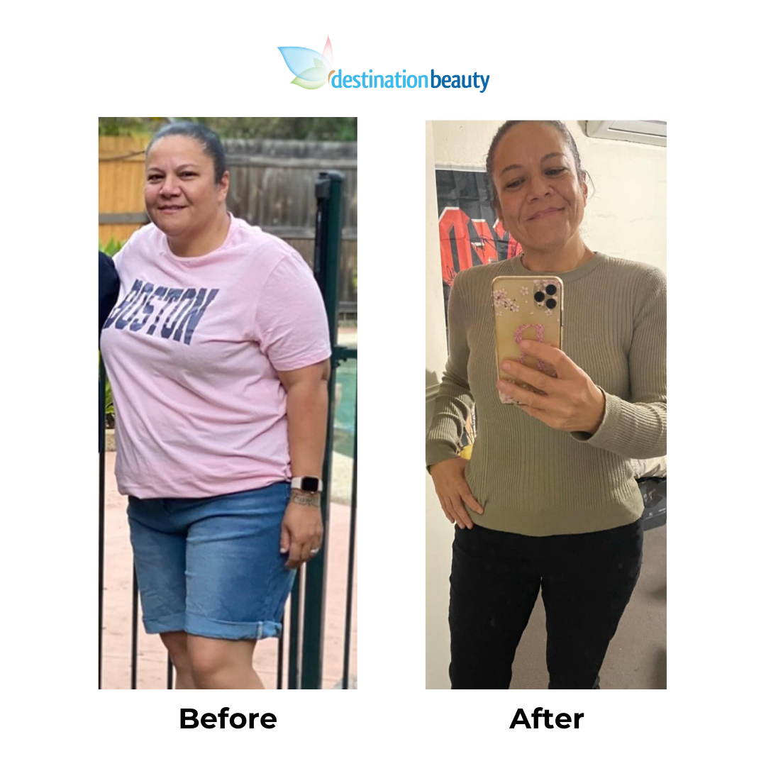 Mary-ro lost 43 kg after WLS (2)