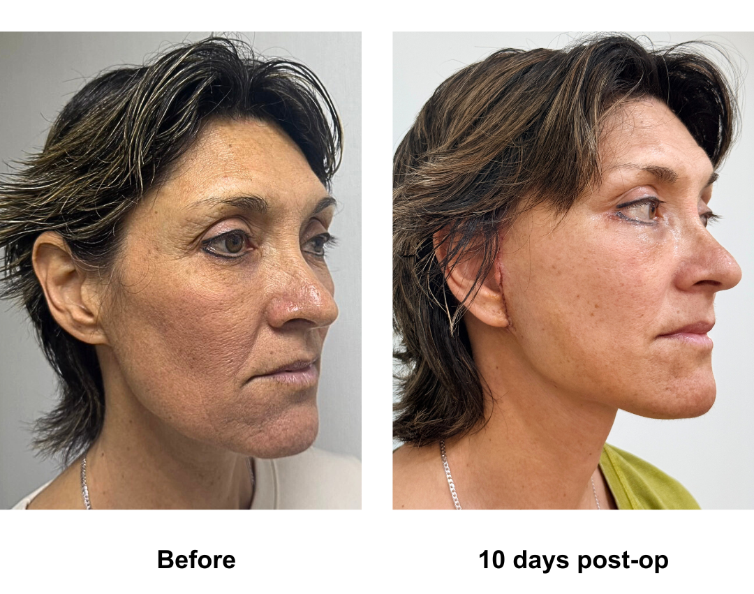 Maryann had FFNL+LB with Dr. Ring (1)-1