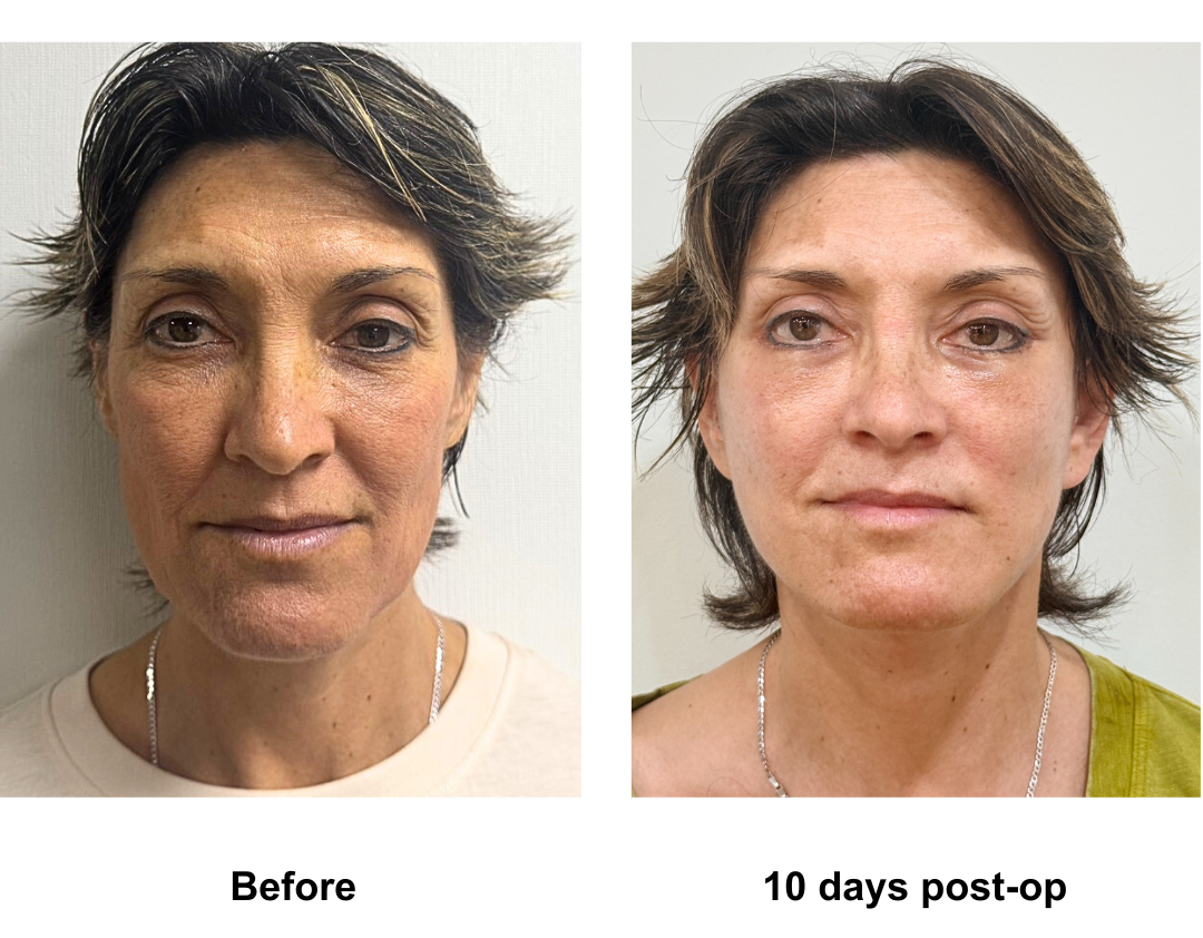 Maryann had FFNL+LB with Dr. Ring-1