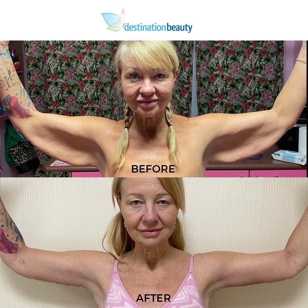 Megan Arm lift before and after 1