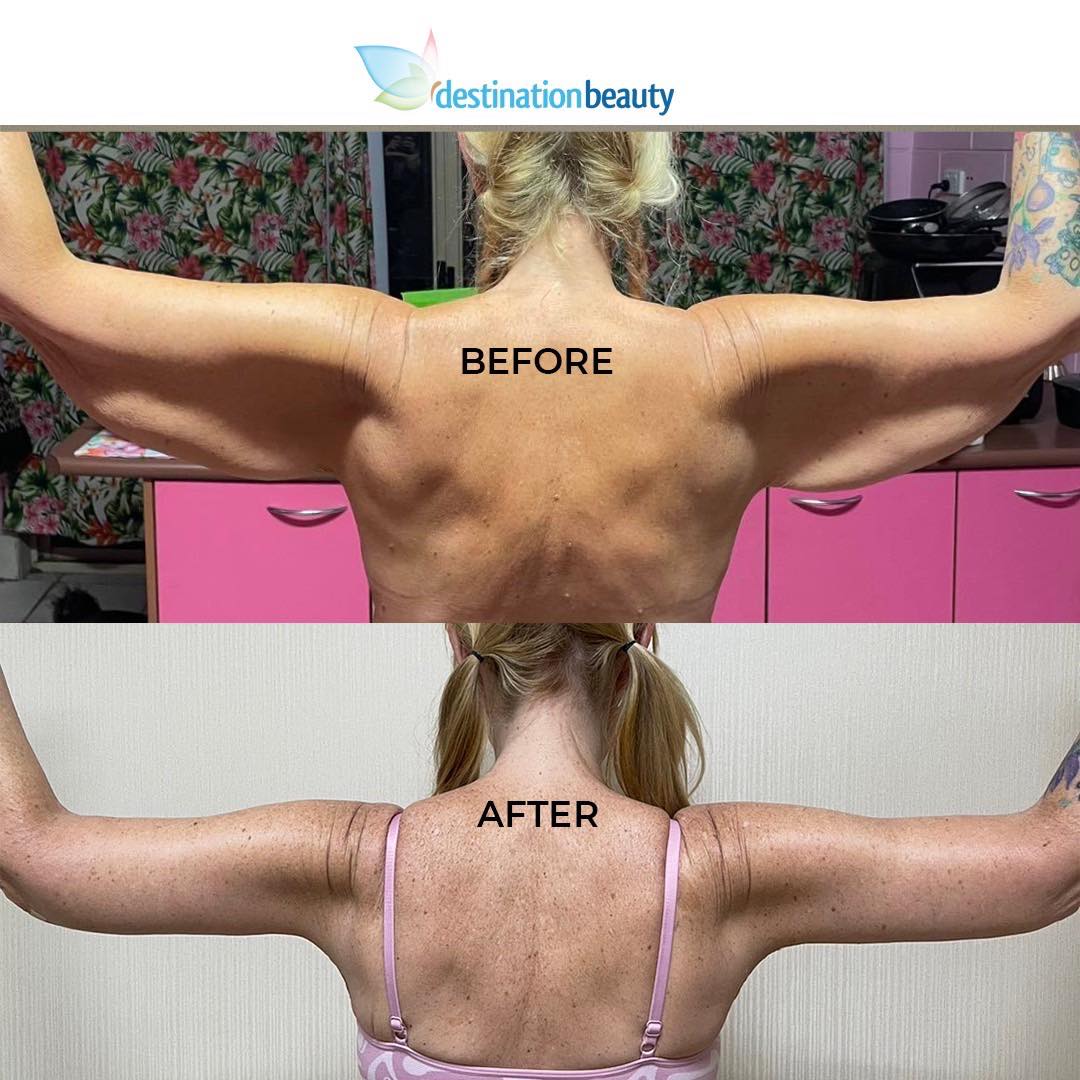 Megan Arm lift before and after 2