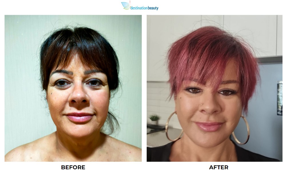 Melanie before after face lift 1