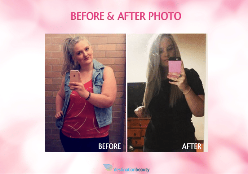 Melanie before and after gastric sleeve surgery thailand