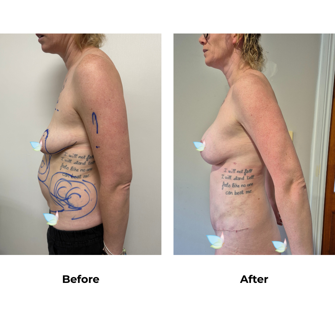 Melanie had BABL + Ex TT + Lipo_2 with Dr. Kasemsak (2)