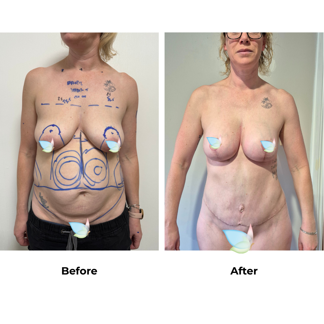 Melanie had BABL + Ex TT + Lipo_2 with Dr. Kasemsak