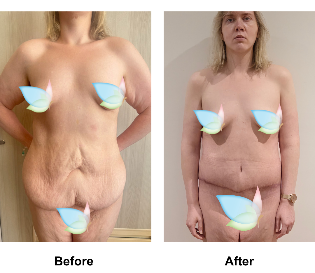 Meredith had AL + CircumTT + Lipo2 + Mons lift