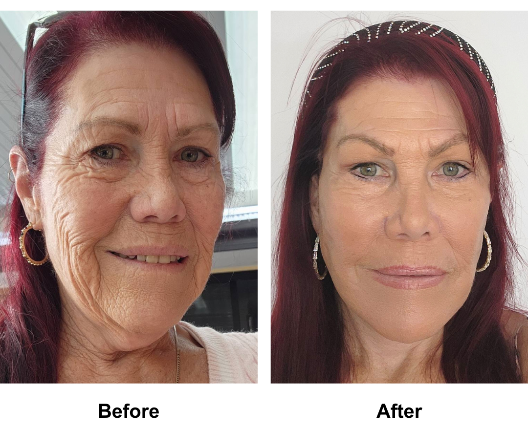 Michelle had FFNL + Chin lift + Direct brow lift + Fat transfer to face with Dr. Ring