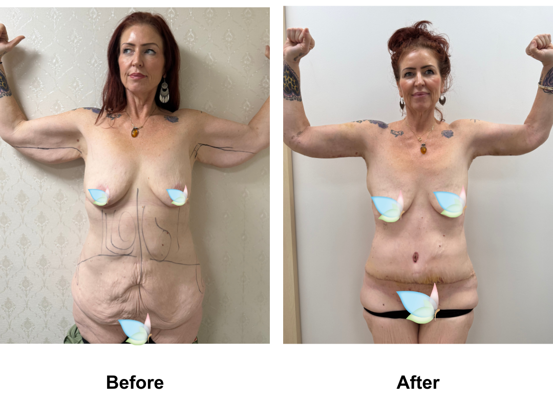 Michelle had SL + AL + Lipo arms + ExTT + ML + Lipo2 with Dr. Ring (1)