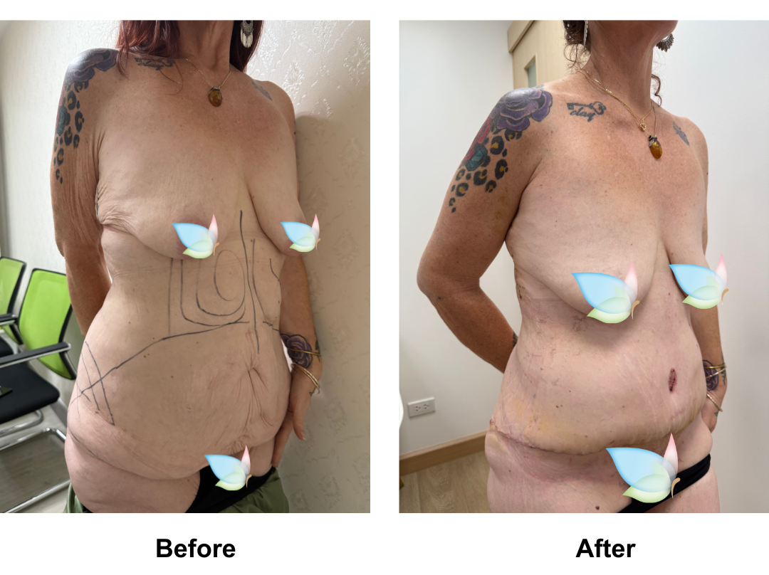 Michelle had SL + AL + Lipo arms + ExTT + ML + Lipo2 with Dr. Ring