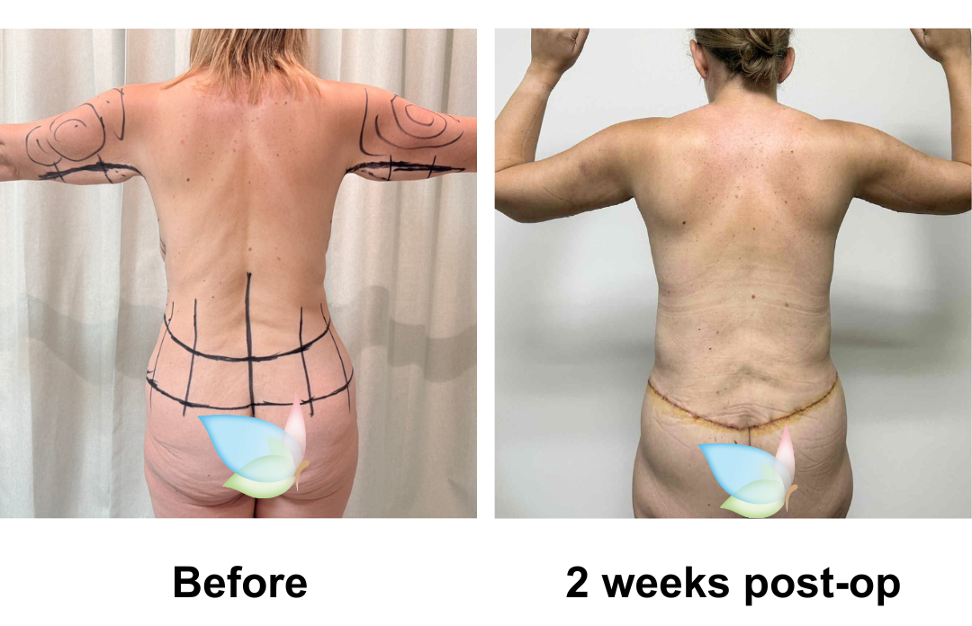 Michelle had SL + AL + Lipo on arm + Circum TT + BABL (285 Demi) + Mons lift + Lipo x2 on upper abs, & love handles  with Dr. Jatuporn (2)