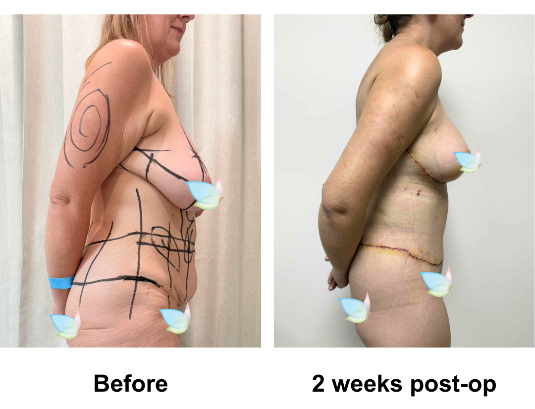Michelle had SL + AL + Lipo on arm + Circum TT + BABL (285 Demi) + Mons lift + Lipo x2 on upper abs, & love handles  with Dr. Jatuporn (3)