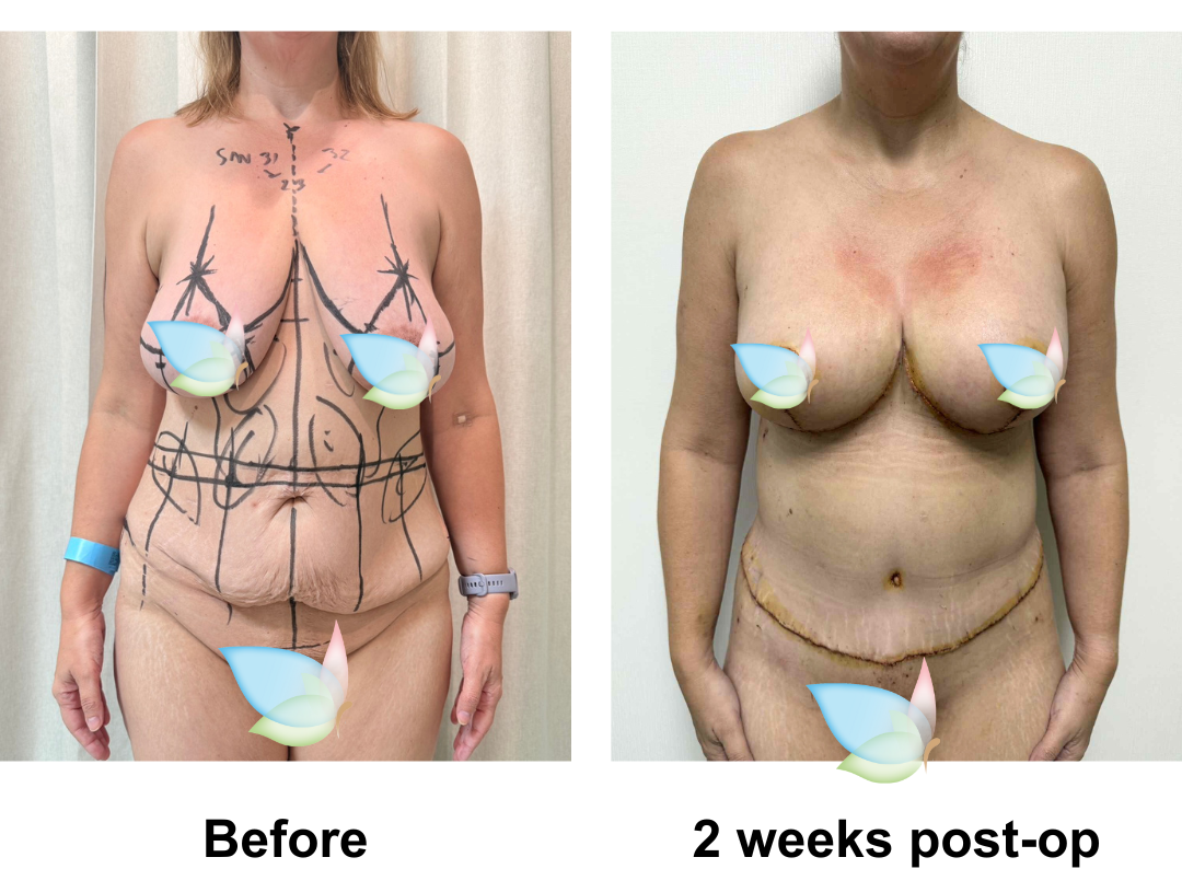 Michelle had SL + AL + Lipo on arm + Circum TT + BABL (285 Demi) + Mons lift + Lipo x2 on upper abs, & love handles  with Dr. Jatuporn