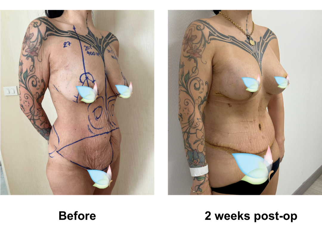 Mihi had BABL (400 HP) + ExTT + Lipo_2 + Mons lift with Dr. Angkana (2)
