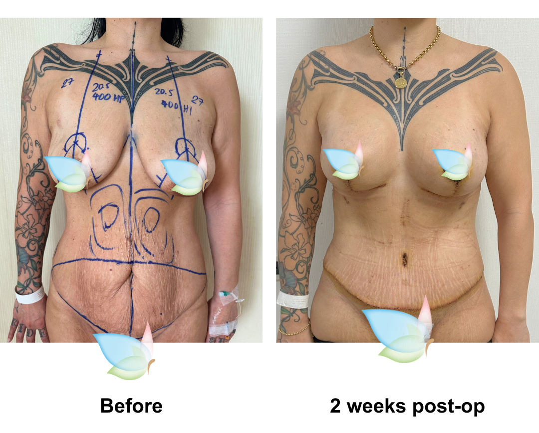 Mihi hadBABL (400 HP) + ExTT + Lipo2 + Mons lift   with Dr. Angkana