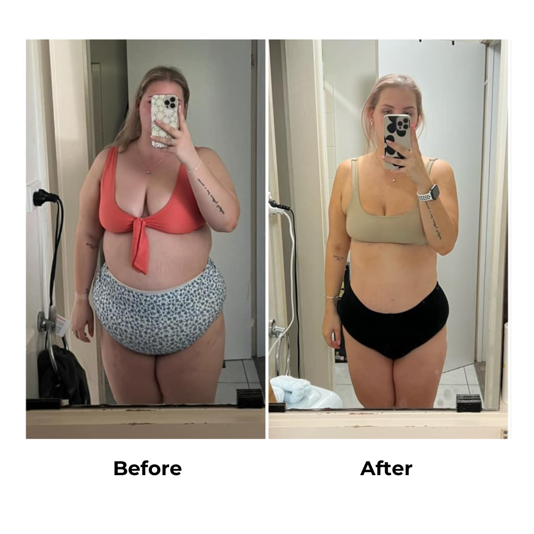 Mikayla had gastric sleeve (2)