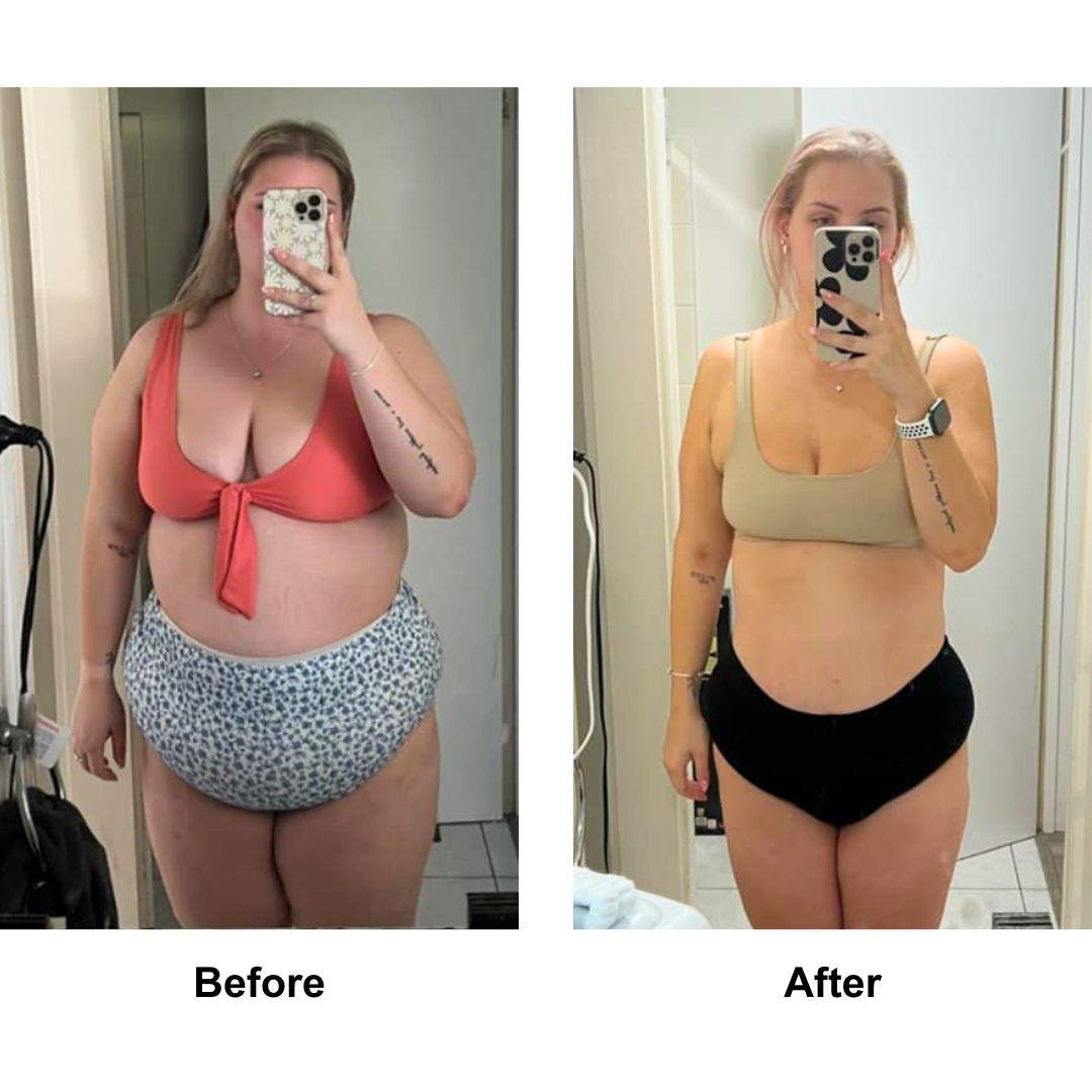 Mikayla had weight loss surgery