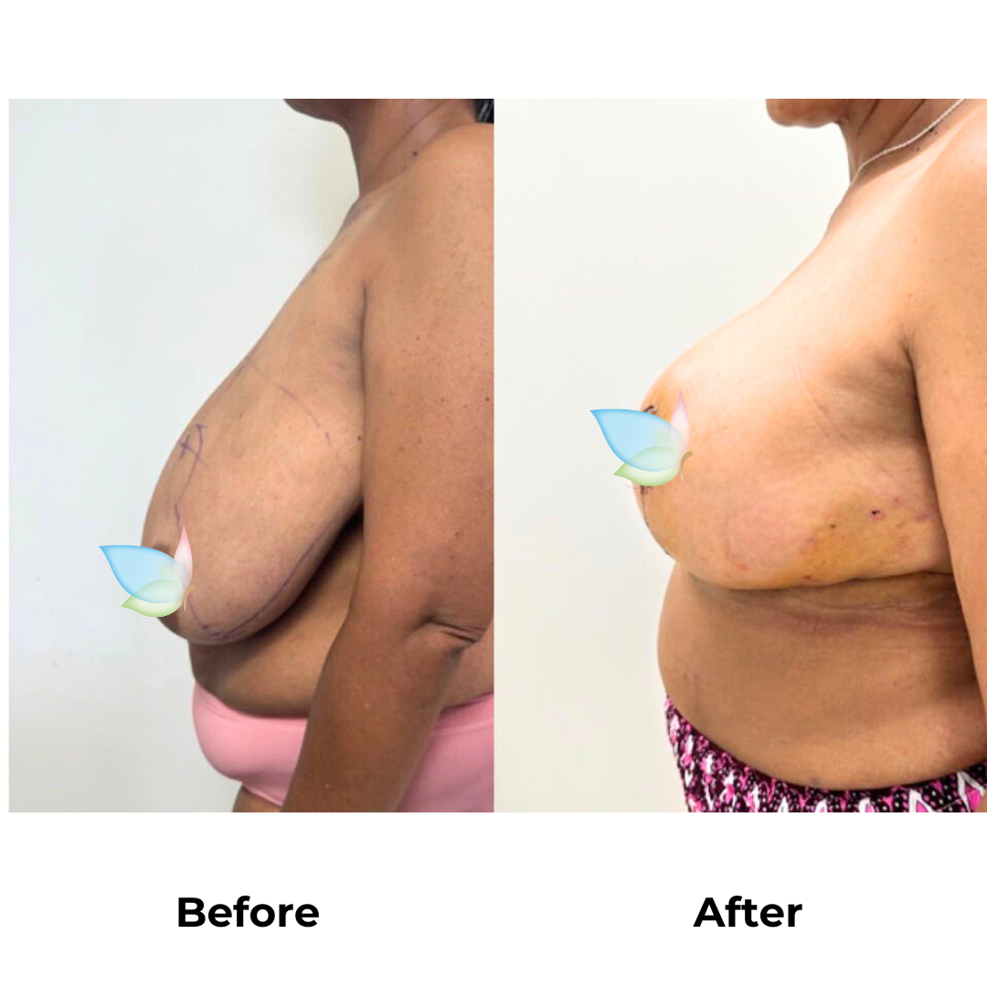 Monique had breast reduction in Thailand (2)