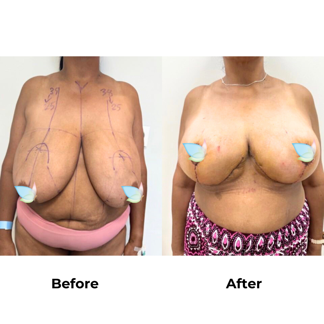Monique had breast reduction in Thailand