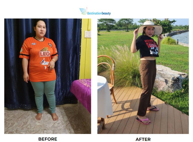 Monrudee weight loss surgery