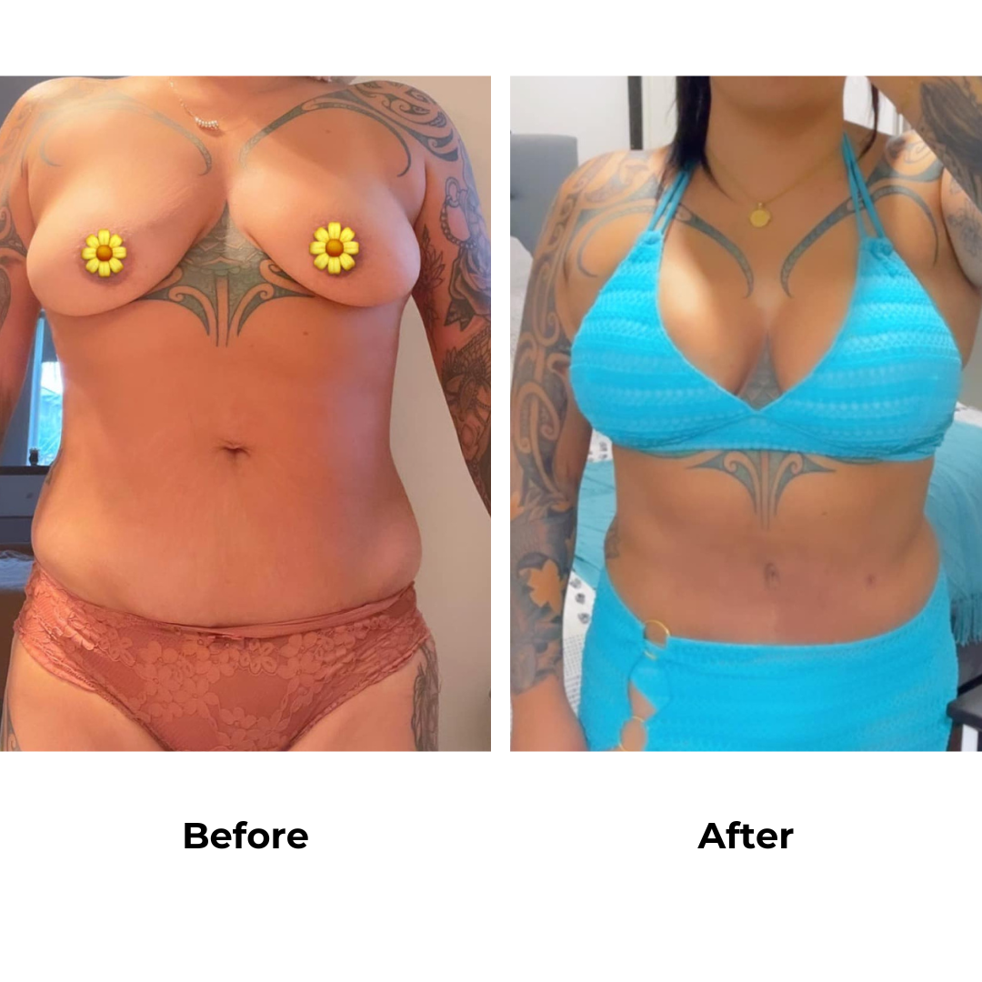 Nadia had BABL TT Lipo2 with Dr. Ring (3)