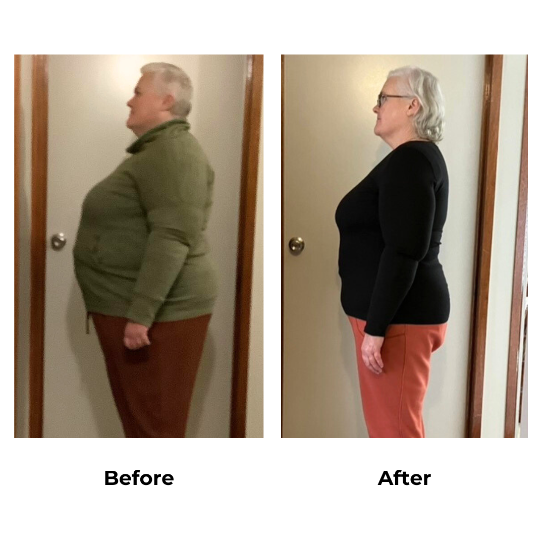 Nadia had gastric sleeve surgery (2)