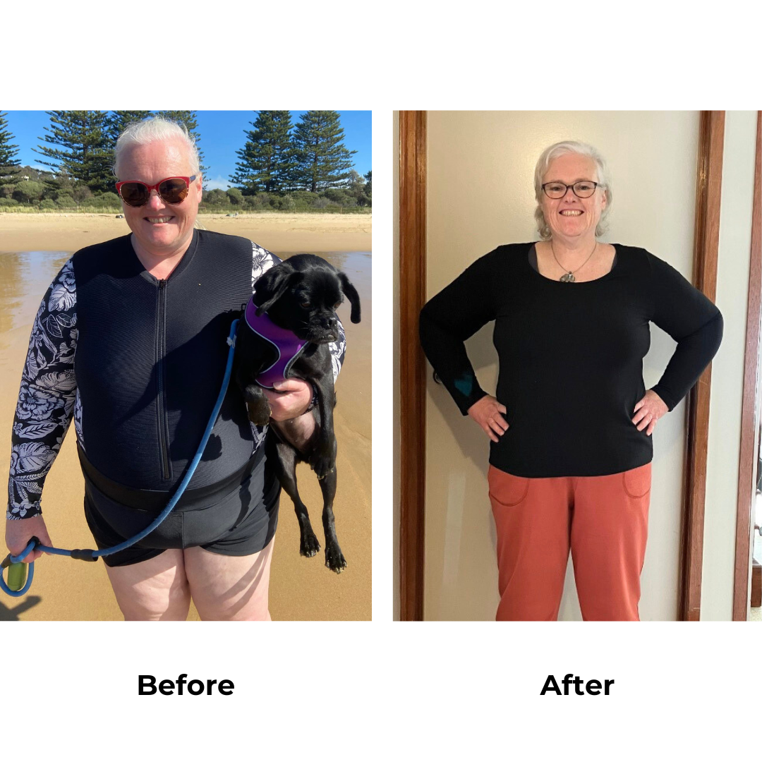 Nadia had gastric sleeve surgery