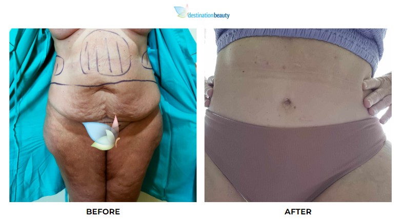 Naomi extended tummy tuck, mons lift, liposuction