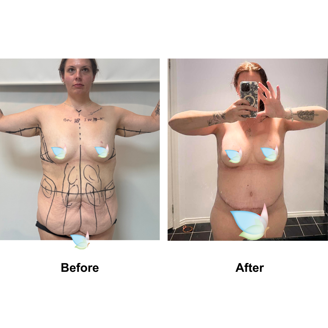 Natalia had BA + SL + AL + Circum TT + ML + Lipo on upper abs with Dr. Jatuporn (1)