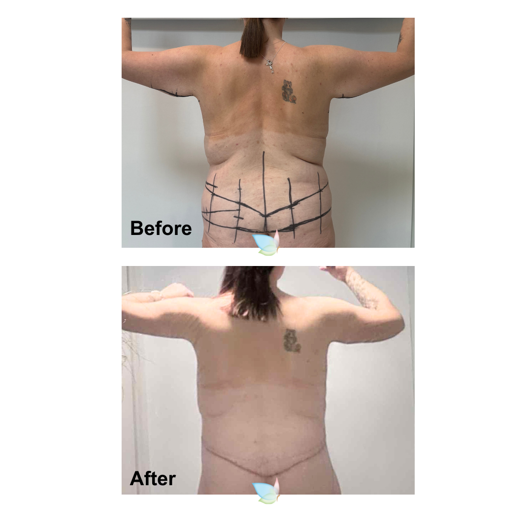 Natalia had BA + SL + AL + Circum TT + ML + Lipo on upper abs with Dr. Jatuporn (3)