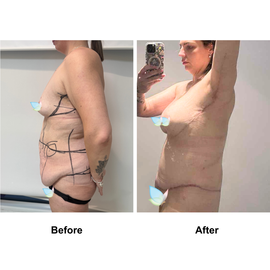 Natalia had BA + SL + AL + Circum TT + ML + Lipo on upper abs with Dr. Jatuporn