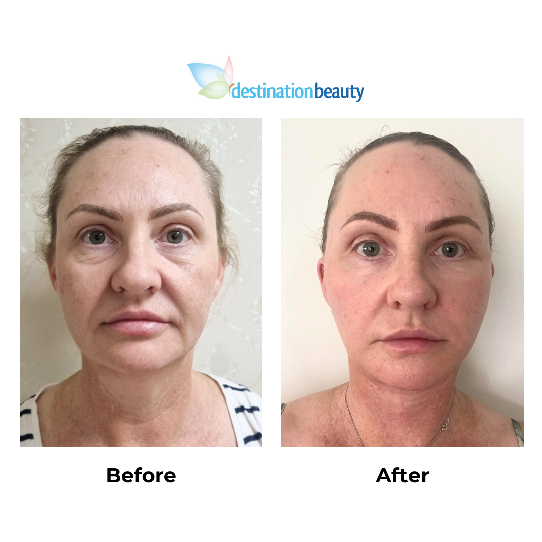 Natasha had MFNL, Chin Lift with Dr. Ring