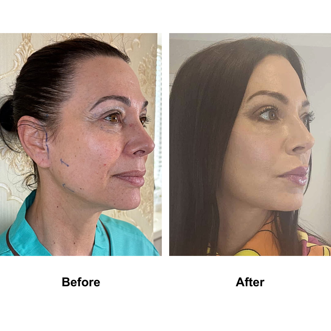 Natashia had MFNL + UB + LB with Dr. Ring (1)