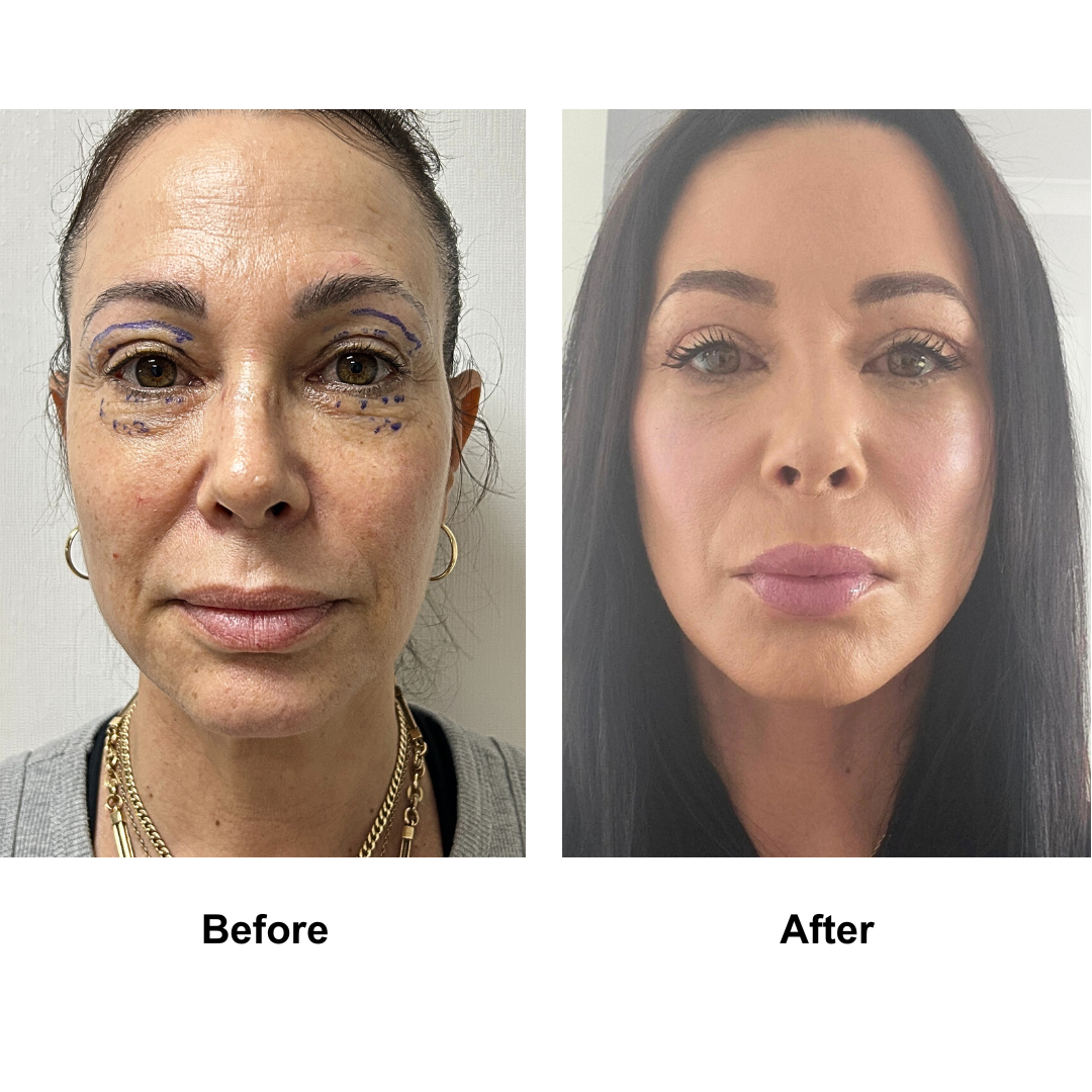 Natashia had MFNL + UB + LB with Dr. Ring (2)