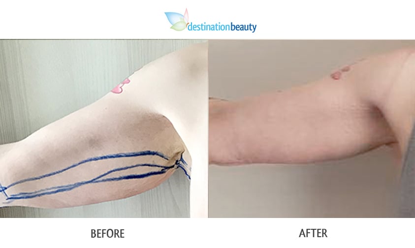 Nicole arm lift and tummy tuck