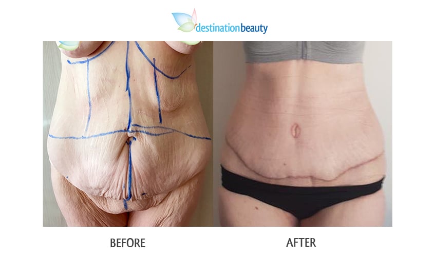 Nicole arm lift and tummy tuck